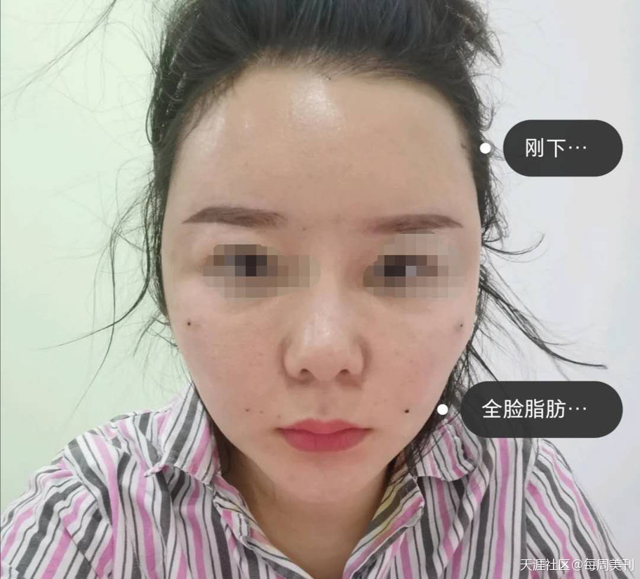 脂肪填充凹凸不平圖片血淚史，不料脂肪填充豐臉幾天能好？重回少女臉(轉(zhuǎn)載)
