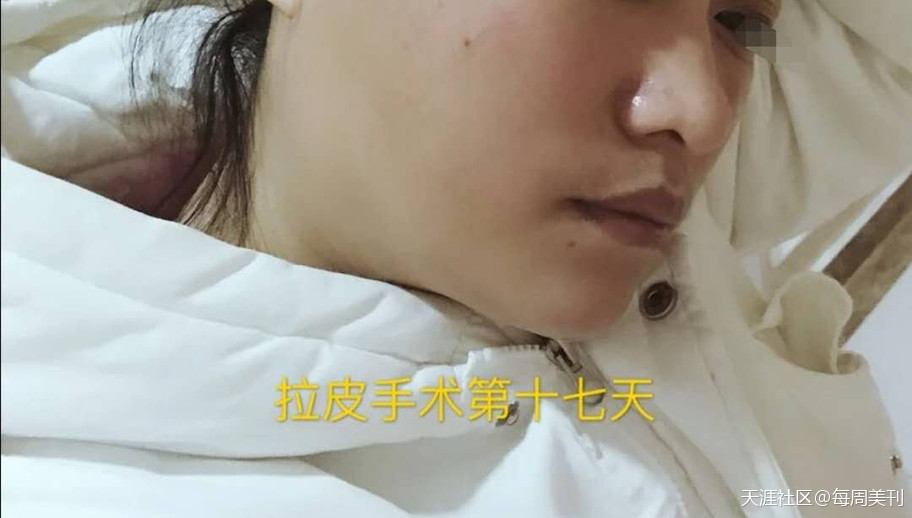 脂肪填充凹凸不平圖片血淚史，不料脂肪填充豐臉幾天能好？重回少女臉(轉(zhuǎn)載)